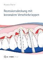 Rezessionsdeckung mit koronalem Verschiebelappen