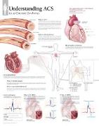Understanding ACS (Acute Coronary Syndrome) Paper Poster