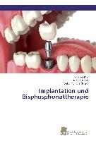 Implantation und Bisphosphonattherapie