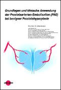 Grundlagen und klinische Anwendung der Prostataarterien-Embolisation (PAE) bei benigner Prostatahyperplasie