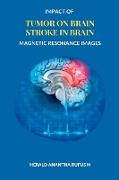 Impact of Tumor on Brain Stroke in Brain Magnetic Resonance Images